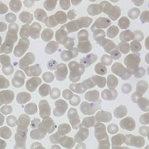 "Ringform" von Plasmodium falciparum in roten Blutzellen. 