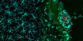 Hirntumor